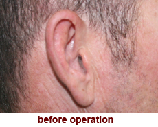 plastic-surgery-prominent-ear 